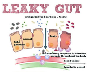 Functional Medicine Naturopathic Medicine Leaky Gut Increased Intestinal Permeability